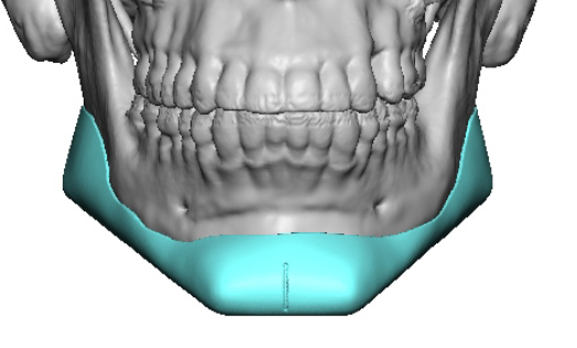 Concepts and Misconceptions of the Square Chin Implant - Explore ...