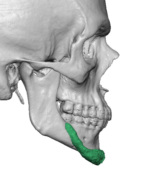 Concepts and Misconceptions of the Square Chin Implant - Explore ...