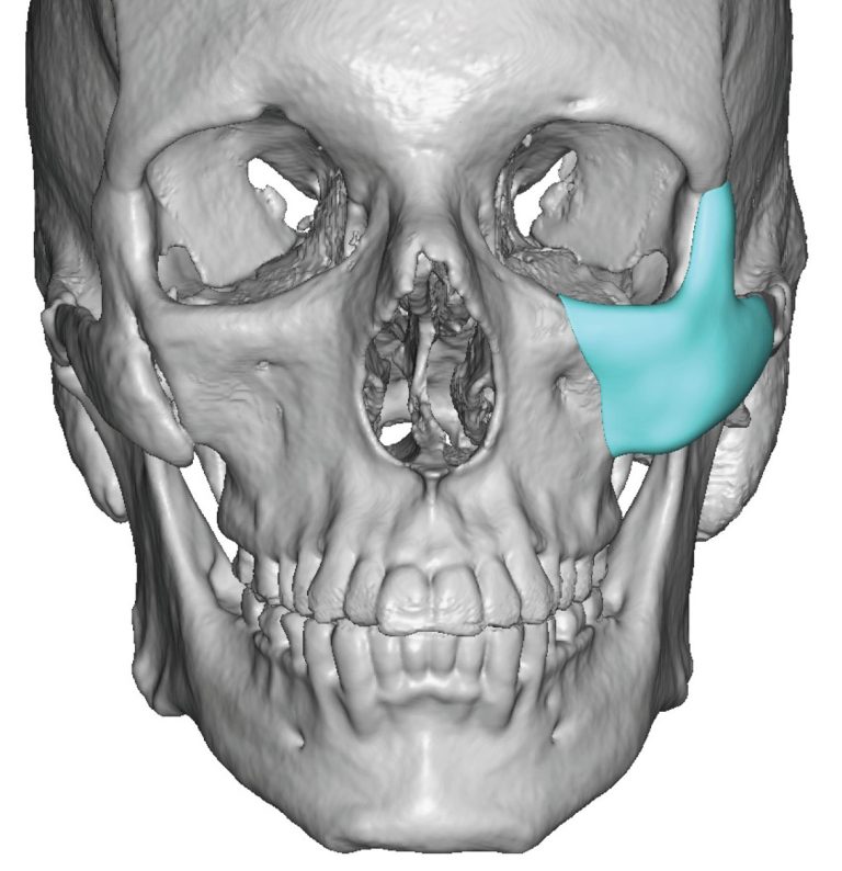 Plastic Surgery Case Study - The Custom Cheek Implant For Depressed Zmc 