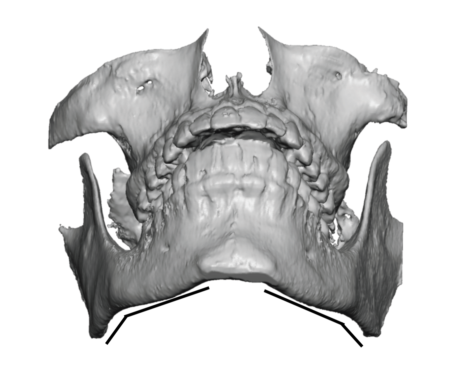 The Bony Anatomy of the Jaw Angles and Its Implications for Good ...