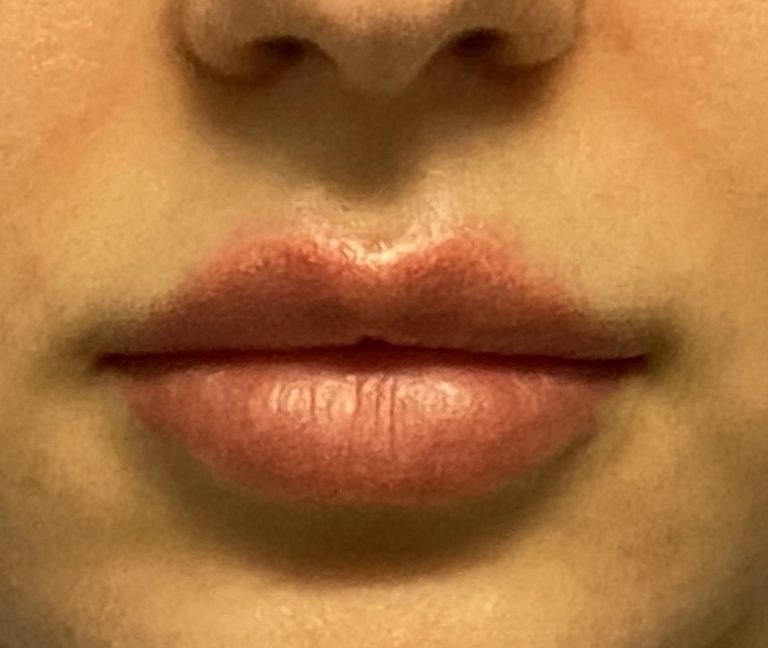 Plastic Surgery Case Study Achieving Permanent Upper and Lower Lip