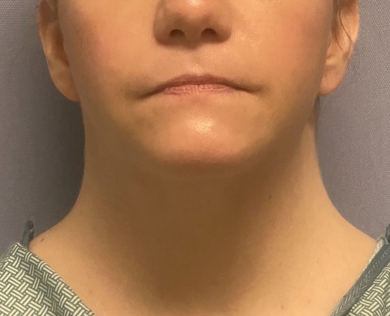 Plastic Surgery Case Study bed Neck Correction Using A Posterior