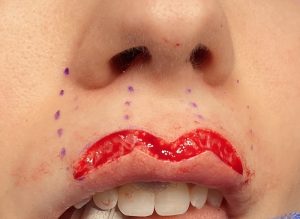 A Permanent Lip Plumper - Cupid's Bow Surgery - AHB