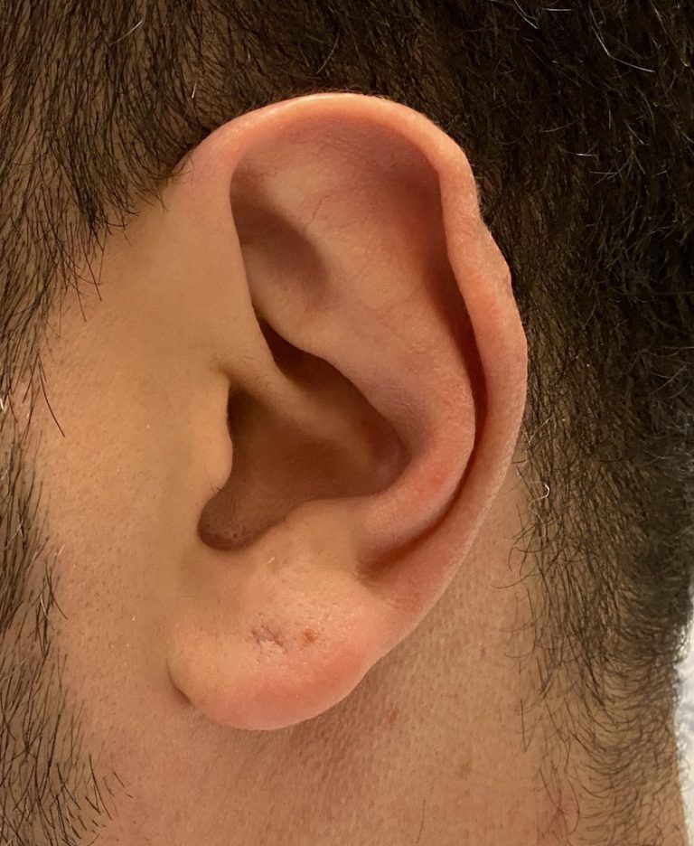 Plastic Surgery Case Study Total Ear Reshaping with Subtotal