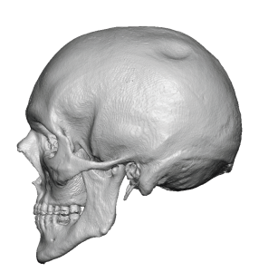 Plastic Surgery Case Study - Small Custom Skull Implant for Circular ...