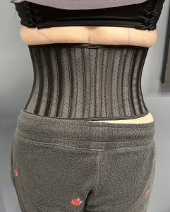 Postoperative Corset vs Waist Trainers in Rib Removal Waistline