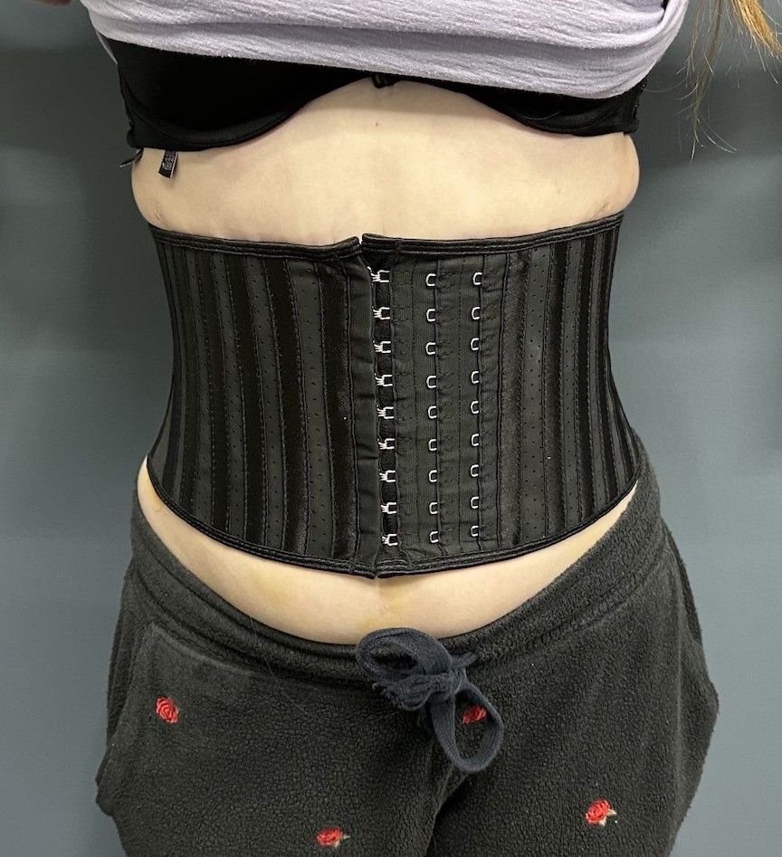 Corseting Garments After Rib Removal Surgery - Explore Plastic Surgery