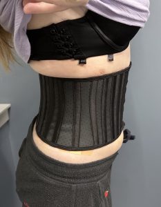 Corset trunkplasty (corset with scar) intraoperative images