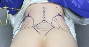 Postoperative Corset vs Waist Trainers in Rib Removal Waistline Narrowing  Surgery - Explore Plastic Surgery