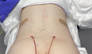 Corseting Garments After Rib Removal Surgery - Explore Plastic Surgery