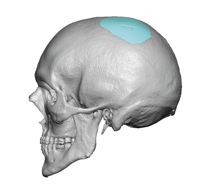 Plastic Surgery Case Study Small Custom Skull Implant for Circular