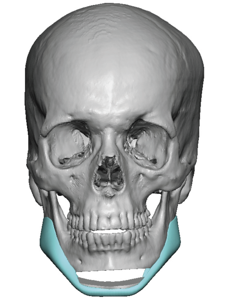 Plastic Surgery Case Study - Vertical Jawline Lengthening with Opening ...