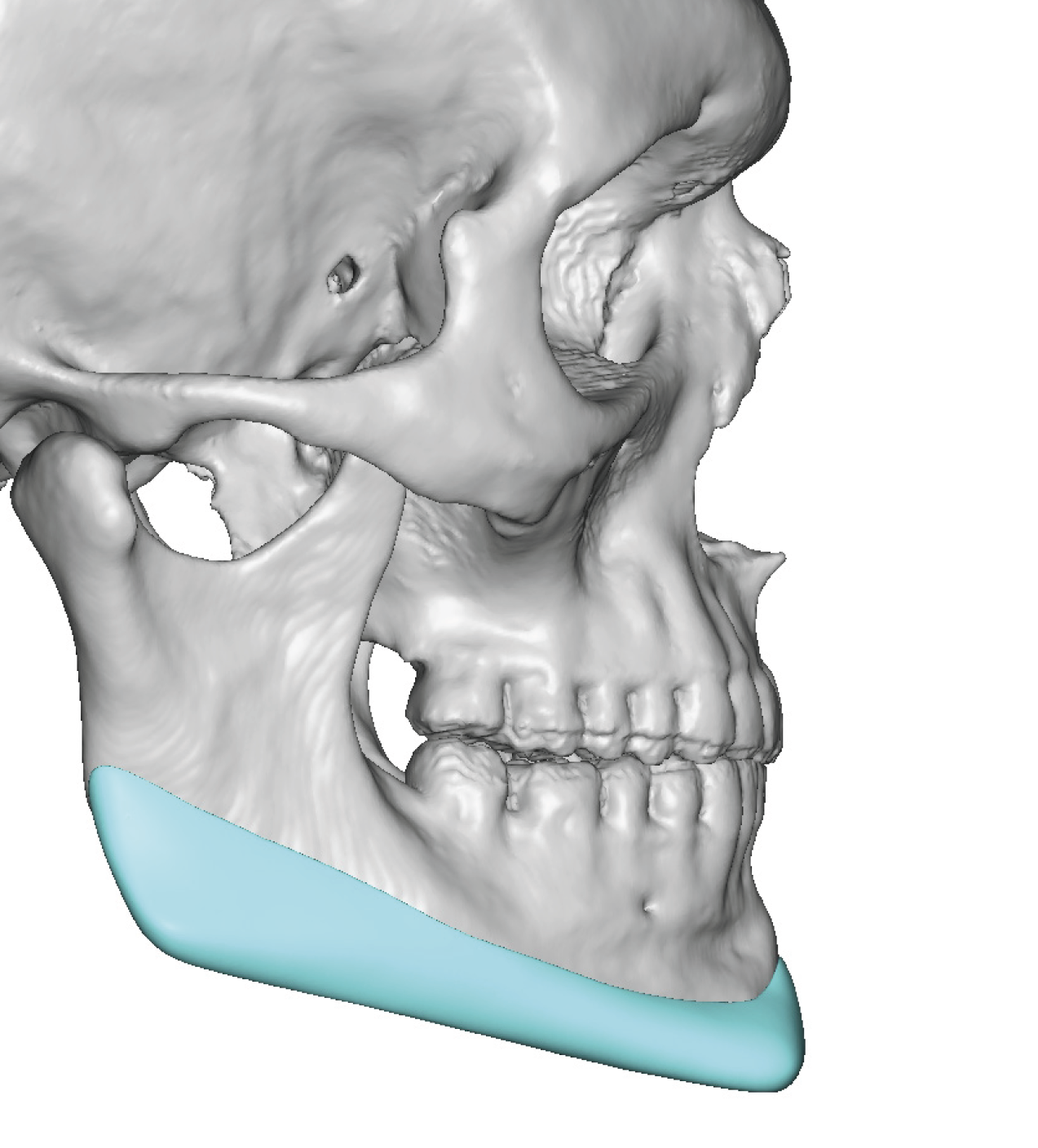 Plastic Surgery Case Study - The Vertical Lengthening Custom Jawline ...