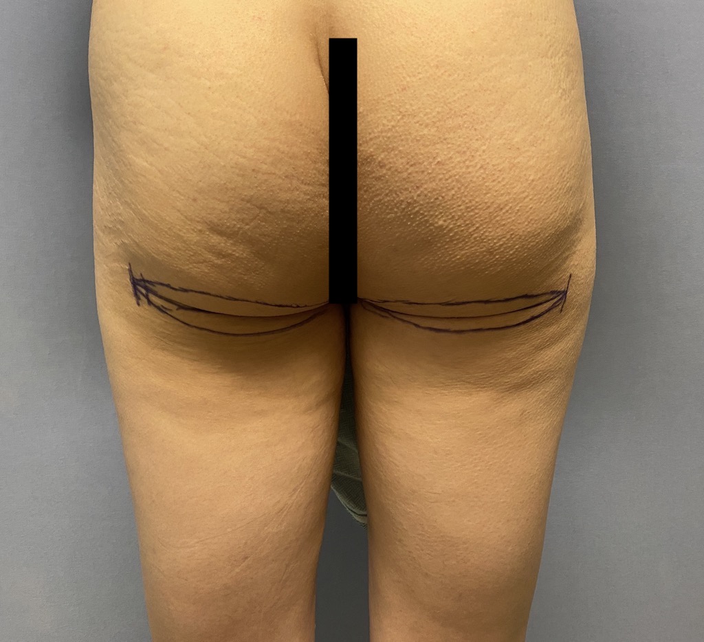 The Lower Buttock Lift That Predates Today's BBL Surgery - Explore
