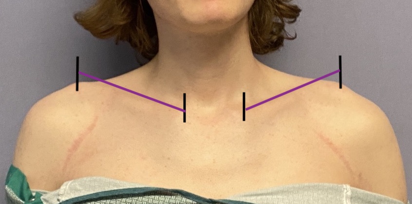 broad shoulders with no clavicle show Dr Barry Eppley copy - Explore  Plastic Surgery
