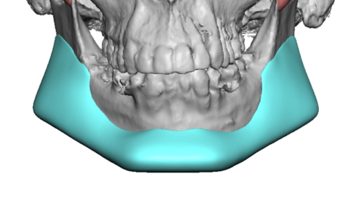 Plastic Surgery Case Study - Custom Jawline Implant Replacement with ...