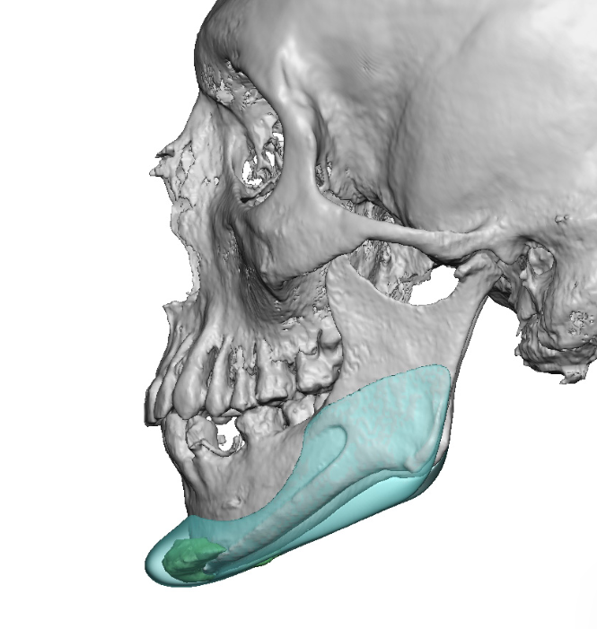 custom jawline implant design vs existing chin implants comparison side ...