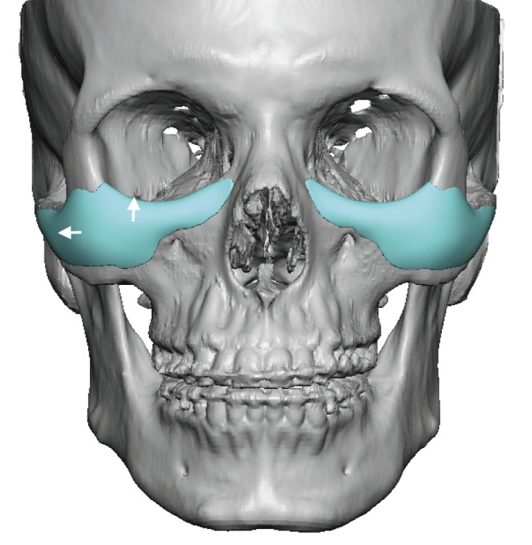 Plastic Surgery Case Study - Intraoperative Modification of Custom ...