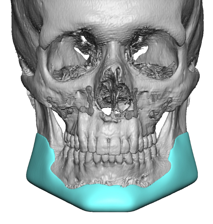 Plastic Surgery Case Study - Custom Jawline Implant For 3d Vertical 