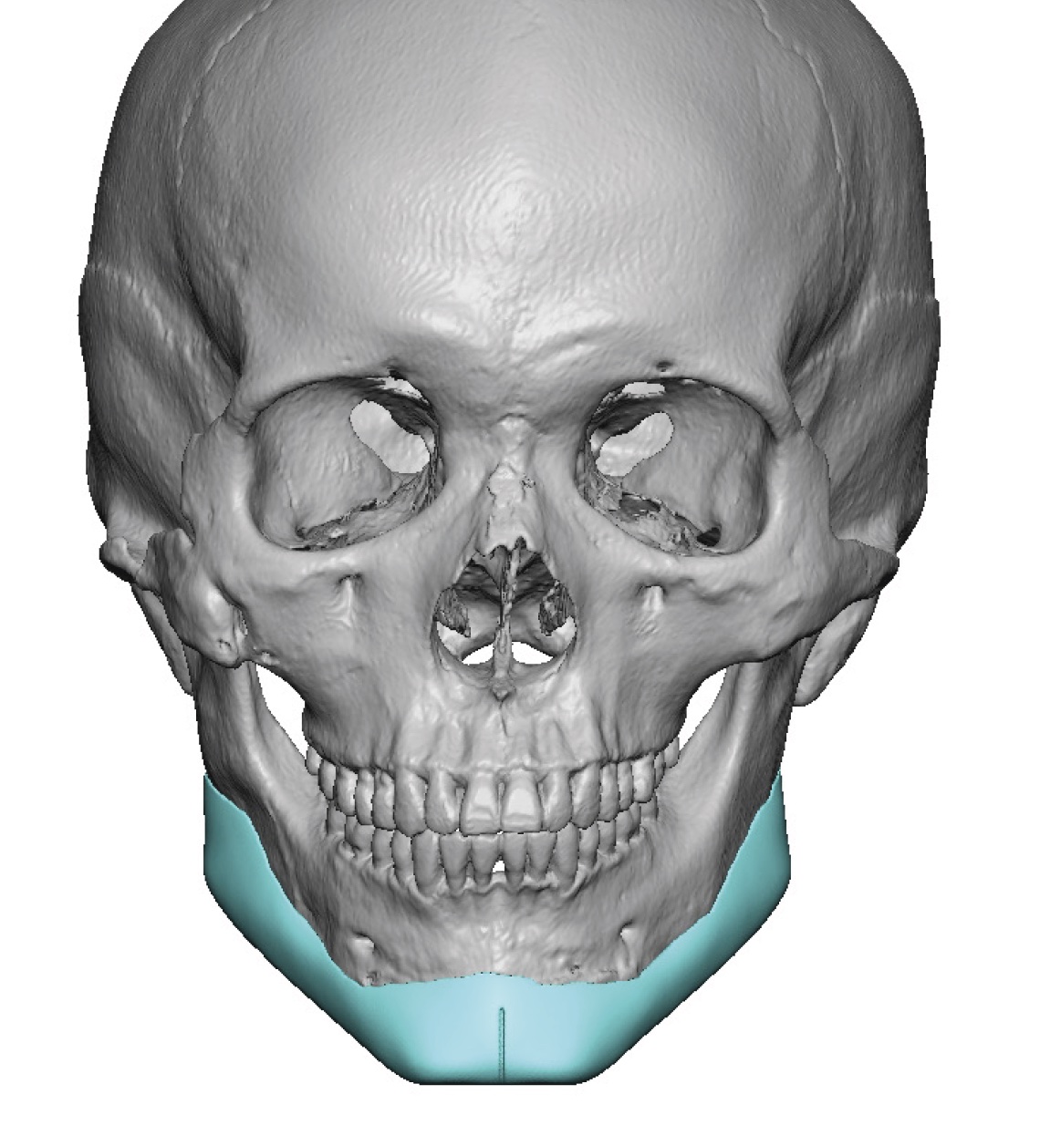 male custom jawline implant replacement design front view Dr Barry ...