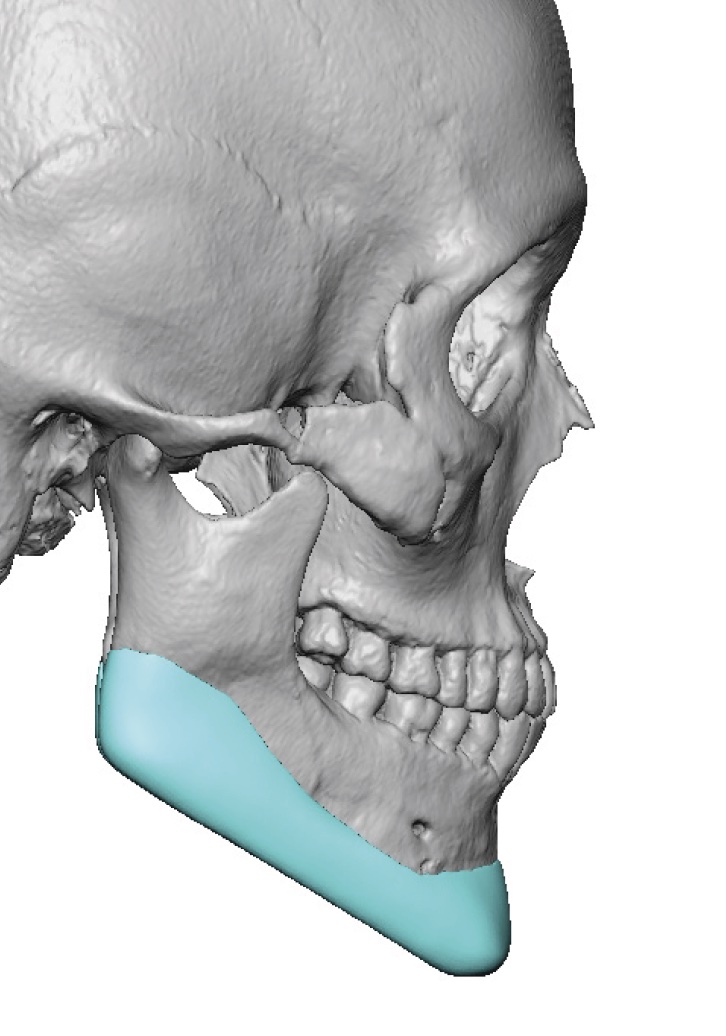 Plastic Surgery Case Study - Custom Jawline Implant Replacement for ...