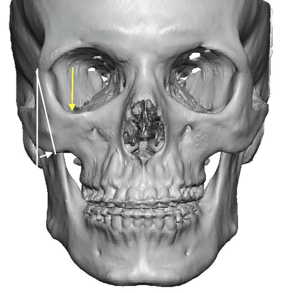 Plastic Surgery Case Study - Intraoperative Modification of Custom ...