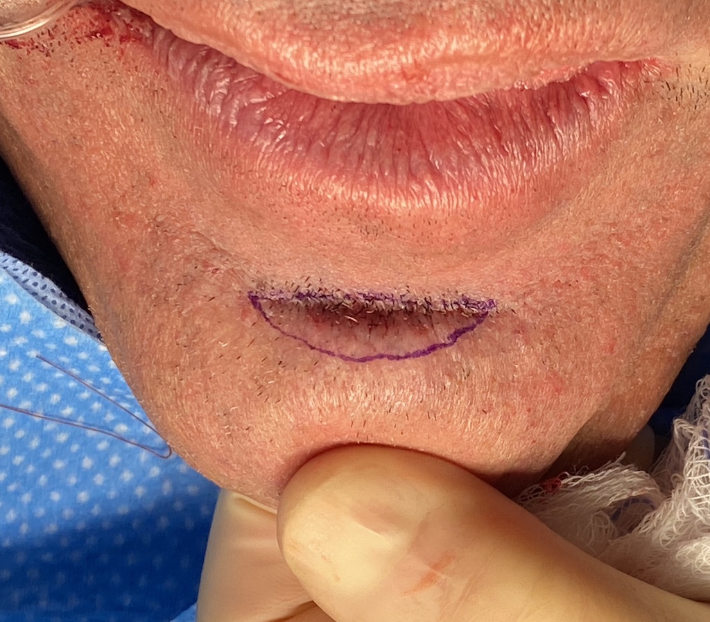 Plastic Surgery Case Study Male Transcutaneous Soft Tissue Chin Pad