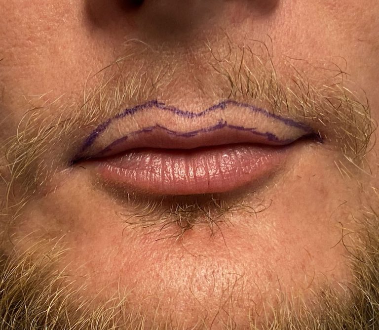 Plastic Surgery Case Study Lip Advancement in the Very Thin Upper