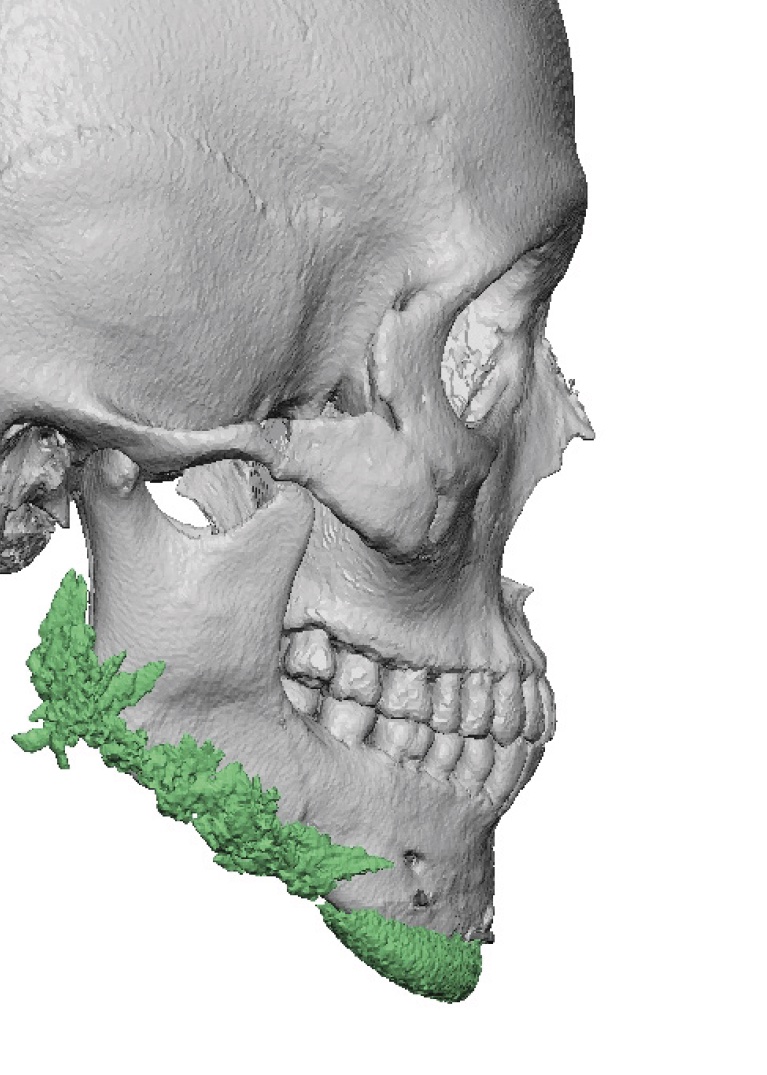 Plastic Surgery Case Study - Custom Jawline Implant Replacement for ...