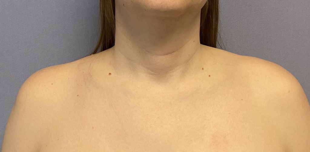 Plastic Surgery Case Study Clavicle Reduction Osteotomies in the