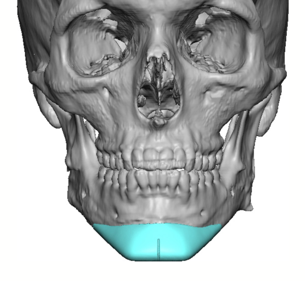 Plastic Surgery Case Study - Secondary Custom Jawline Implant ...