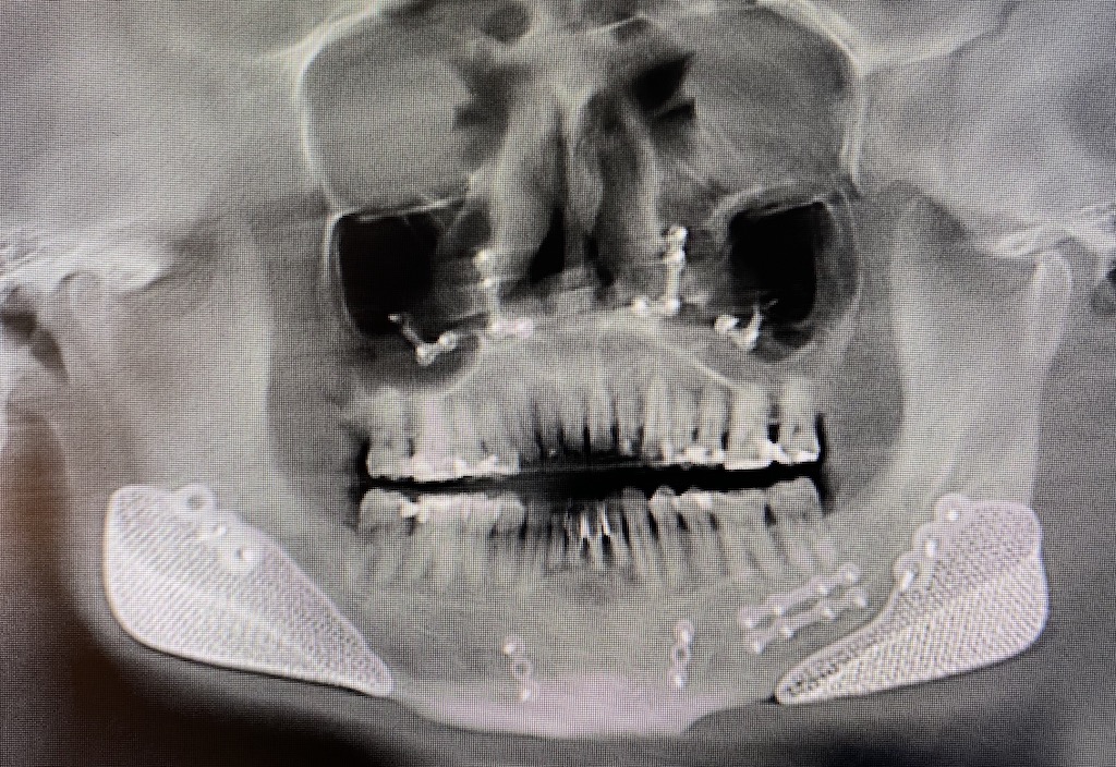 Plastic Surgery Case Study Secondary Adjustment of Malpositioned