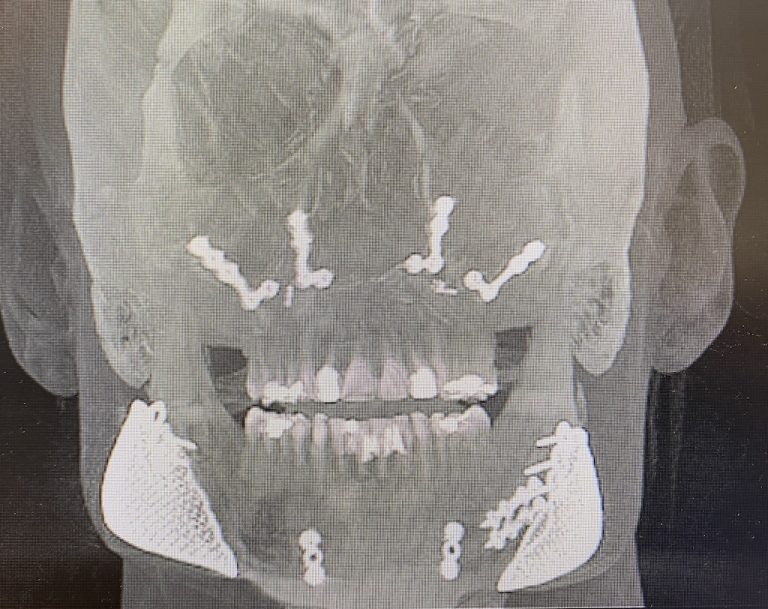 Plastic Surgery Case Study Secondary Adjustment of Malpositioned