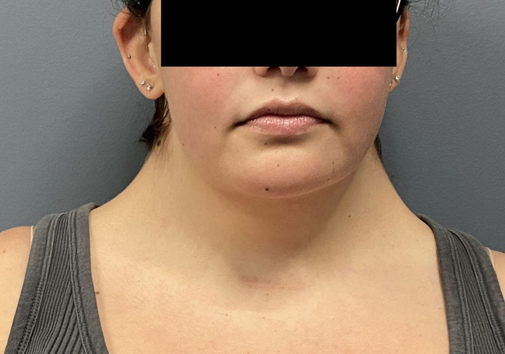 Plastic Surgery Case Study bed Neck Correction with Buffalo Hump