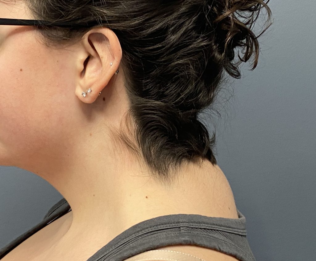 Plastic Surgery Case Study bed Neck Correction with Buffalo Hump