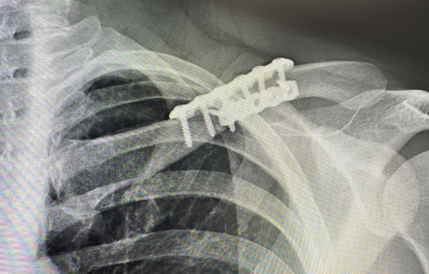 female left shoulder red postop xray Dr Barry Eppley - Explore Plastic ...