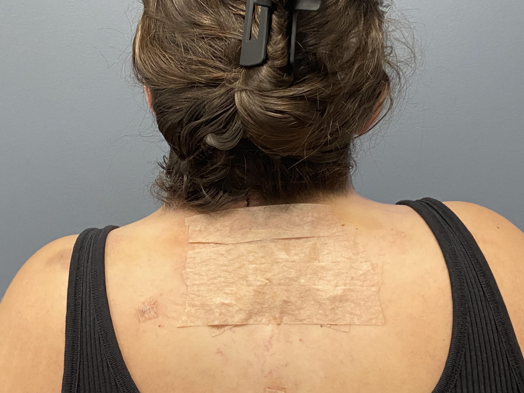 Plastic Surgery Case Study bed Neck Correction with Buffalo Hump