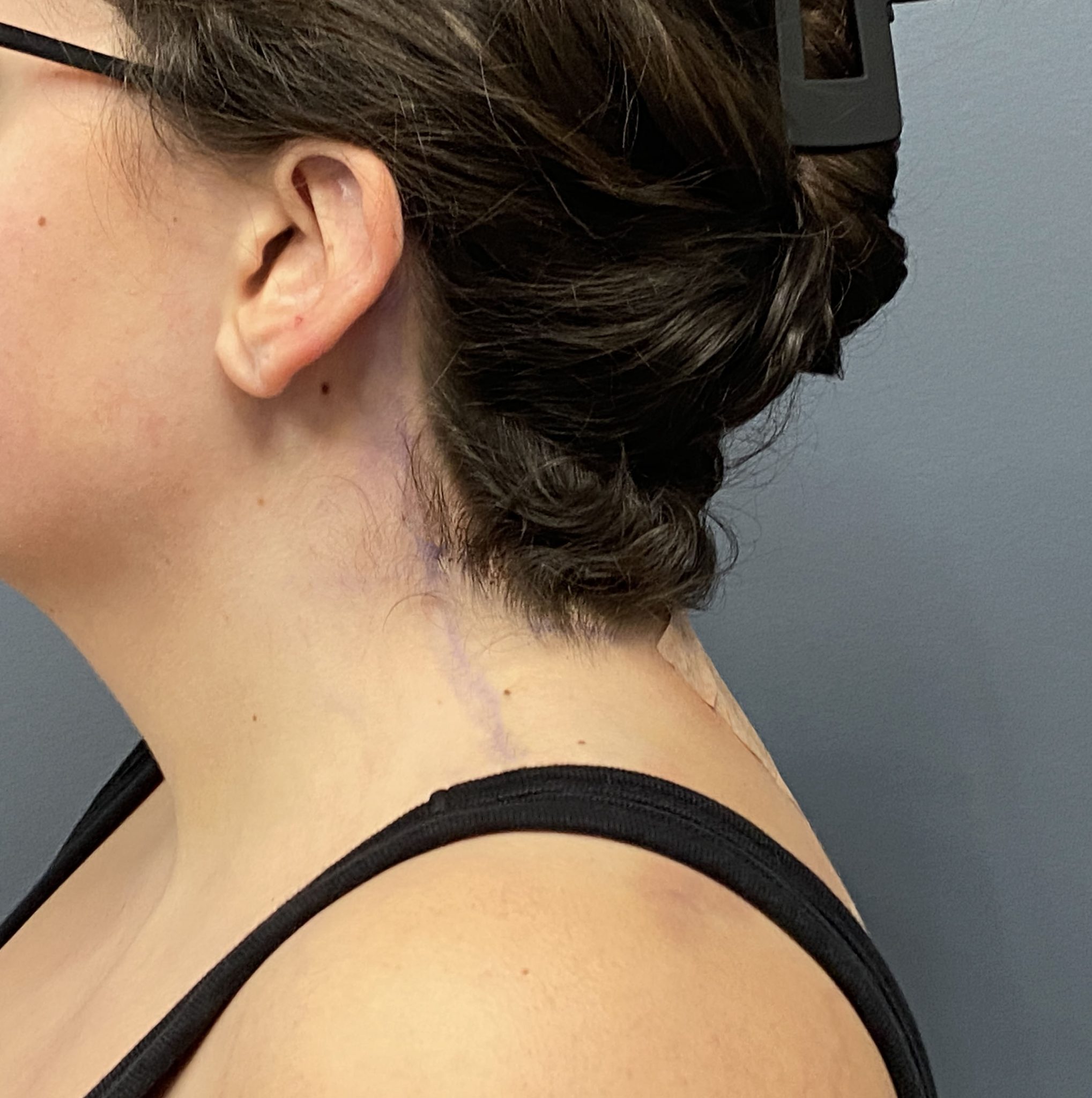 Plastic Surgery Case Study bed Neck Correction with Buffalo Hump