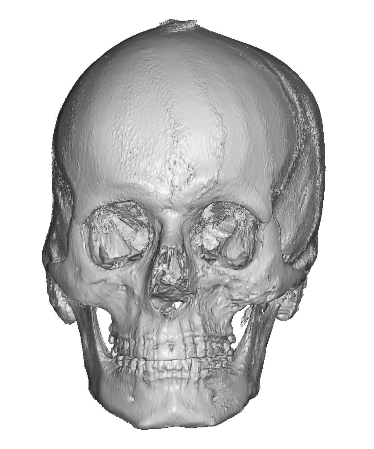 Cranial Asymmetry