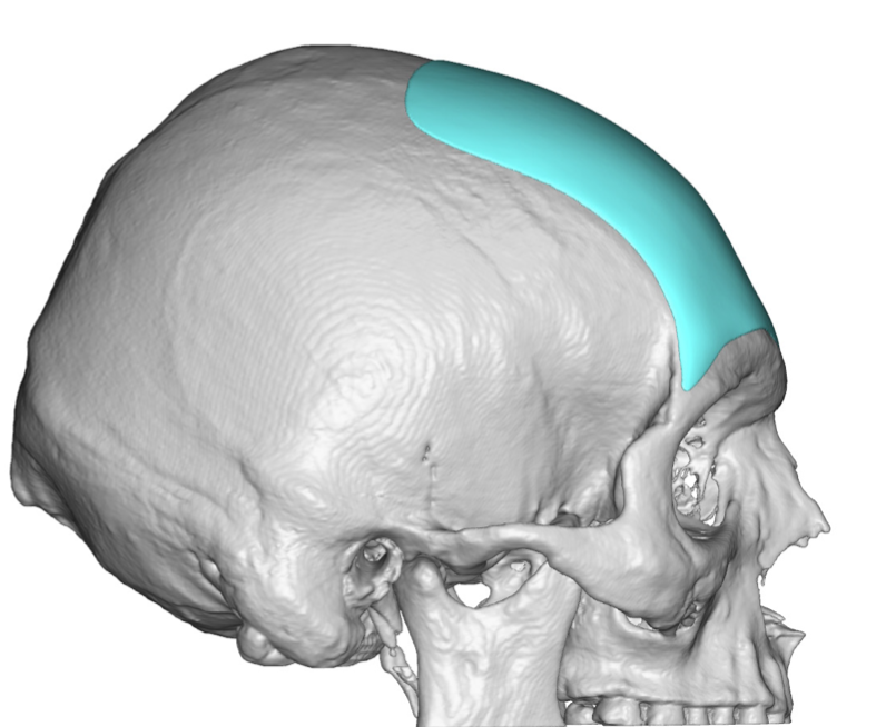 Plastic Surgery Case Study Custom Forehead Implant Augmentation in