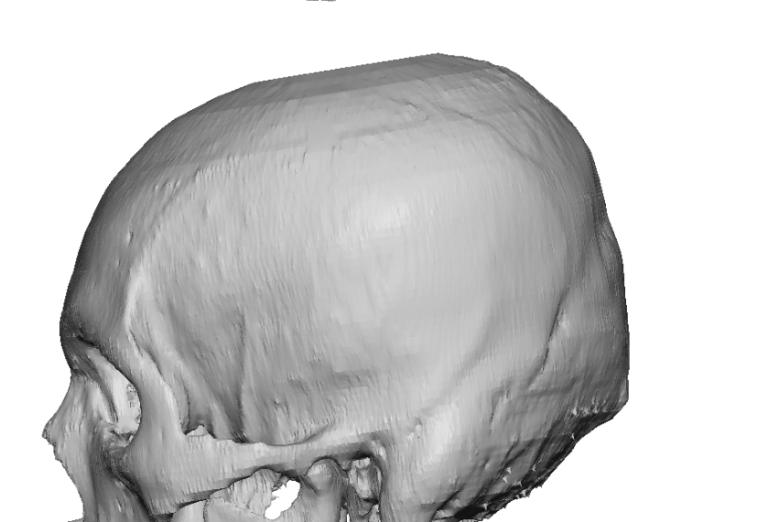 Plastic Surgery Case Study - Custom Skull Implant Augmentation for Male ...