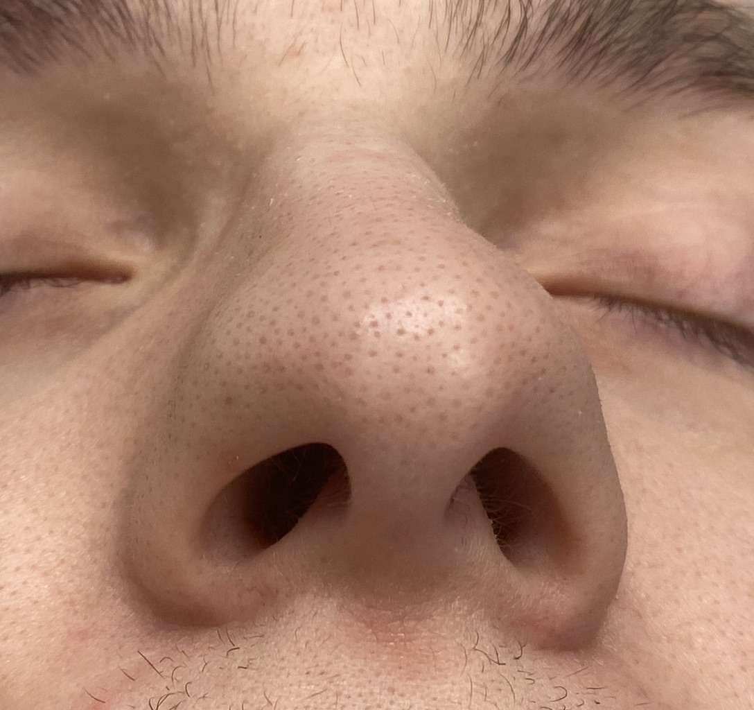 Plastic Surgery Case Study - Narrowing the Wide Male Nasal Tip (Tip