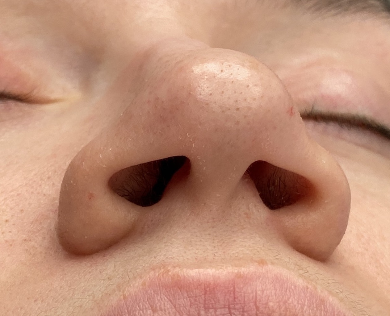 Plastic Surgery Case Study The Long Nose Rhinoplasty with Tip