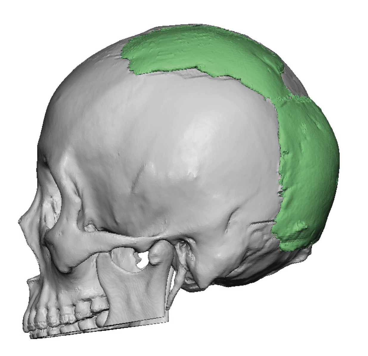 Plastic Surgery Case Study - The Aesthetic Advantages of a Custom Skull ...