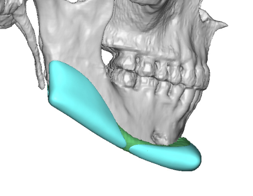 Plastic Surgery Case Study - Secondary Custom Chin And Jaw Angle 