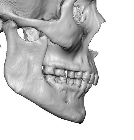 Plastic Surgery Case Study - Custom Chin Implant Reversal of a ...