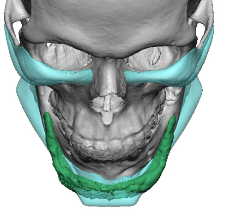 Plastic Surgery Case Study - Custom Jawline Implant Replacement For A ...