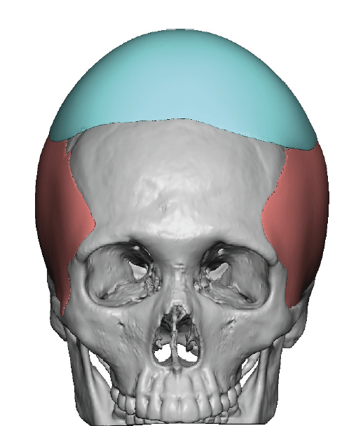 Plastic Surgery Case Study - Custom Skull Implant After PMMA Bone ...