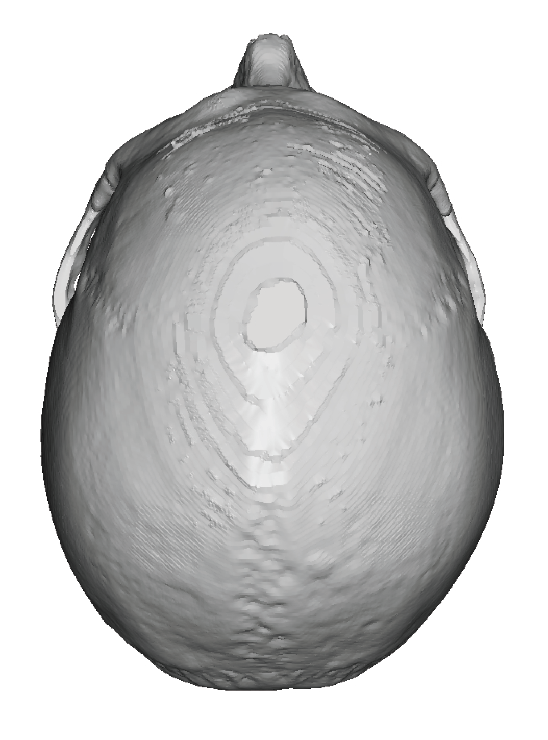 flat back of the head 3D CT scan top view Dr Barry Eppley - Explore ...