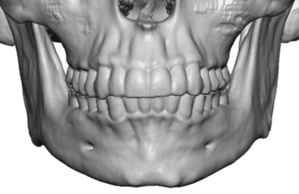 intermediate developed lateral chin tubercles Dr Barry Eppley - Explore ...